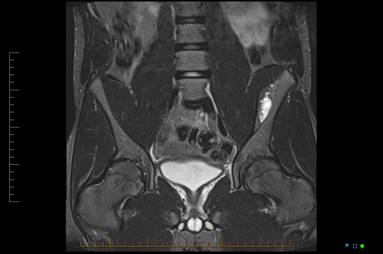 Figure 2 for case Fibrous dysplasia